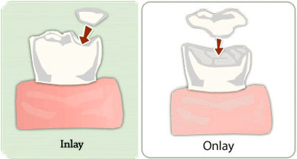 Inlays/Onlays
