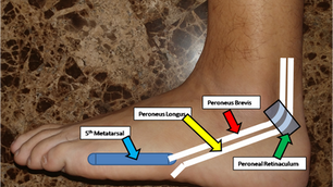 Peroneal Tendon and Lateral Ankle Pain