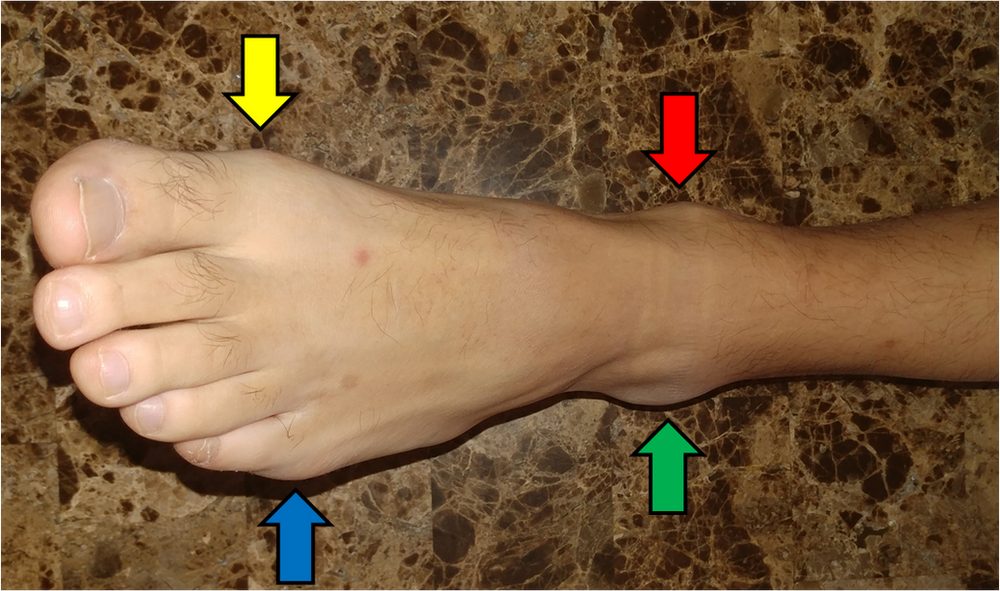 Surface Anatomy of the Foot
