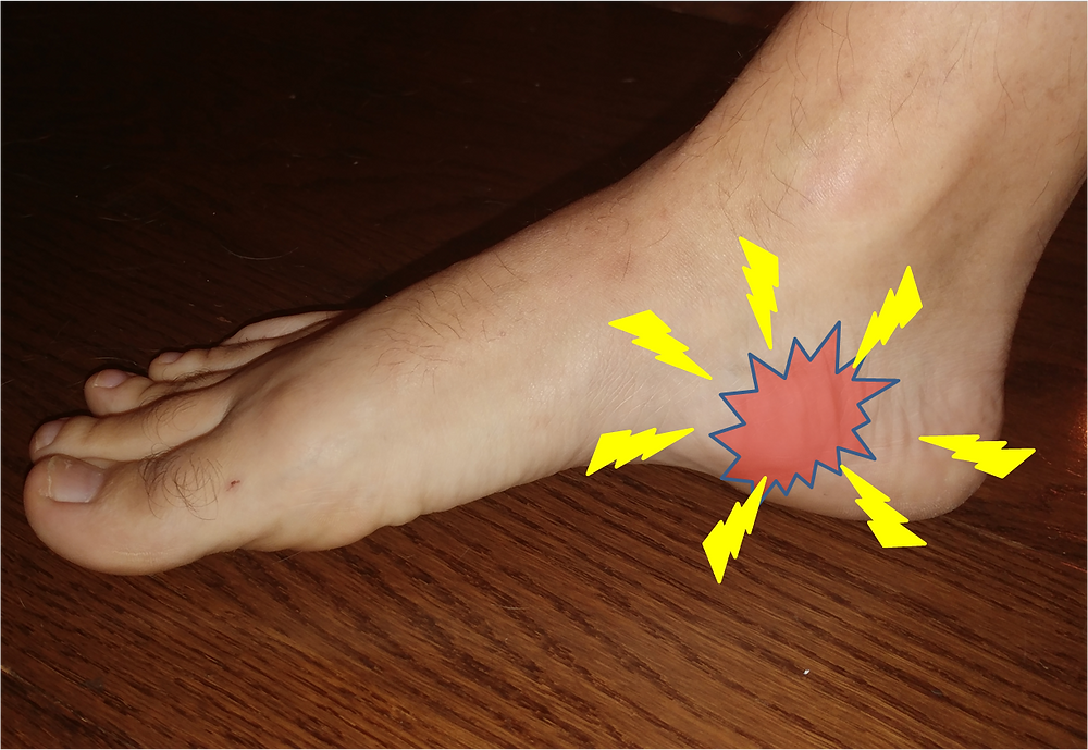 Heel spurs and Baxter’s Nerve entrapment