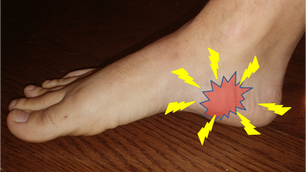 Heel spurs and Baxter’s Nerve entrapment