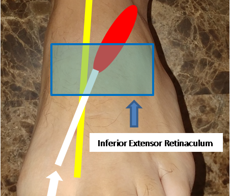 Anterior Tarsal Tunnel Syndrome