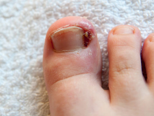 Ingrown toenail