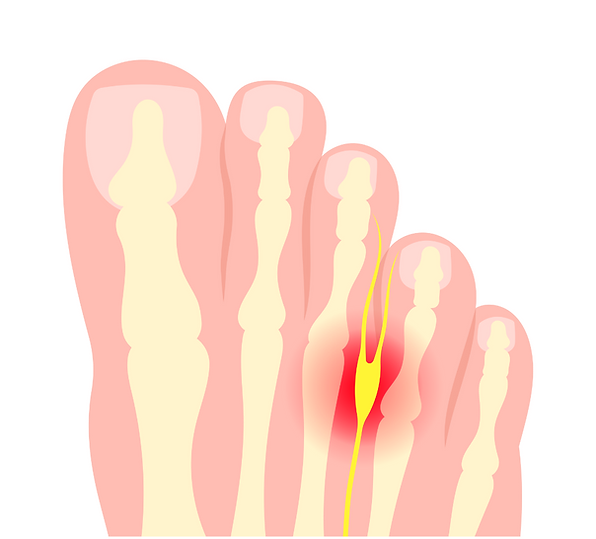 Neuroma
