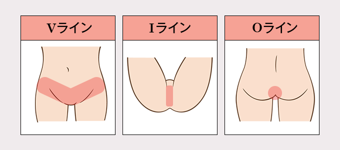 Vioモニター募集 メンズ ブラジリアンワックス脱毛