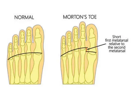 Morton's toe meaning for vitamin B6 and the Importance of P5P Supplementation