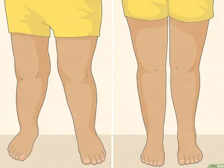 Shoe Inserts for Knock Knees to Improve Posture & Balance