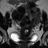 Miomas Uterinos - FIGO