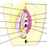 Cáncer de Vulva