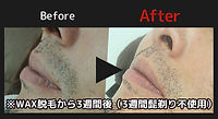 ヒゲ脱毛