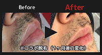 ヒゲ脱毛