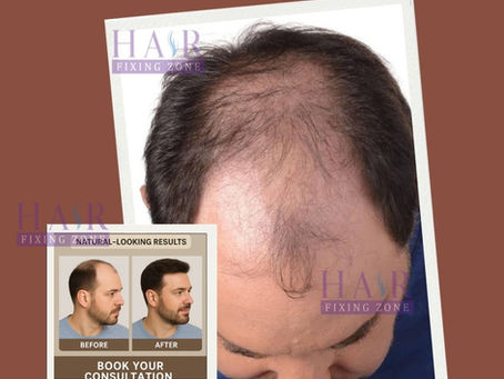 Non-Surgical Hair Fixing for Male Pattern Baldness — 100% Natural Look!”