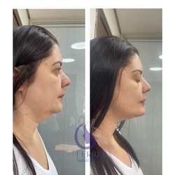 lift facial
