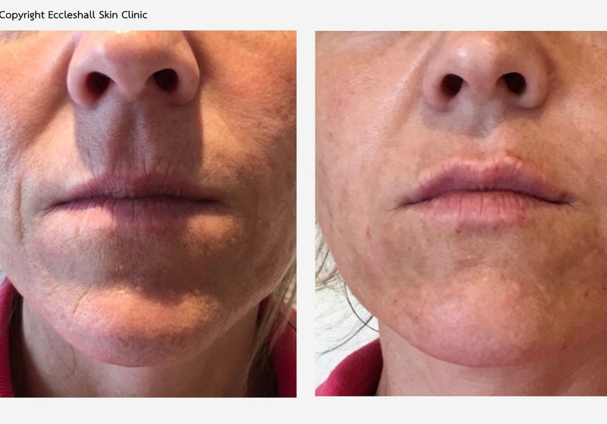 Lips, Nose to Mouth Lines, Mouth Corners