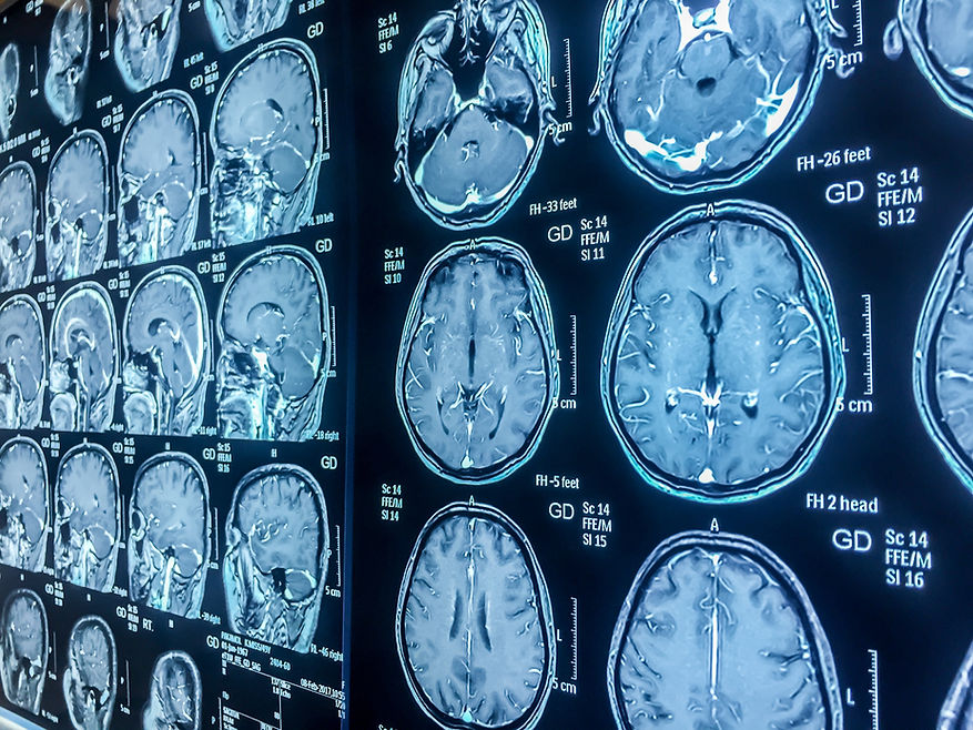 Normal MRI brain study.jpg