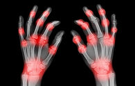 hand_arthritis_600.jpg