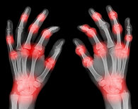 hand_arthritis_600.jpg