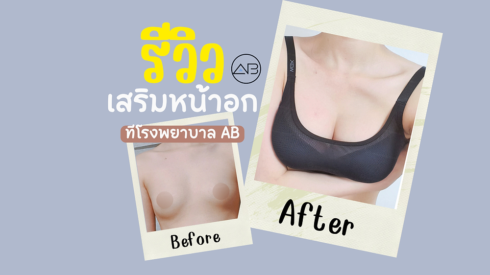 รีวิวศัลยกรรมเสริมหน้าอก โรงพยาบาลเอบี