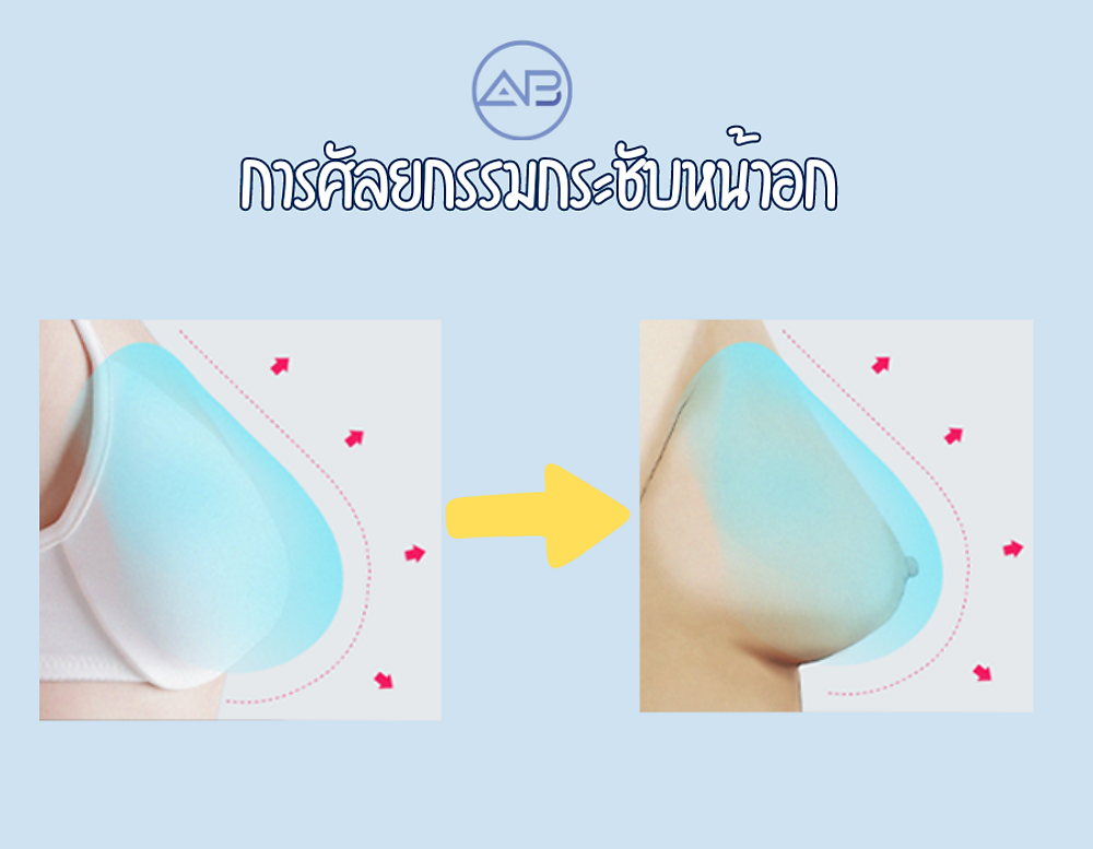 การศัลยกรรมกระชับหน้าอก ที่โรงพยาบาลเอบี
