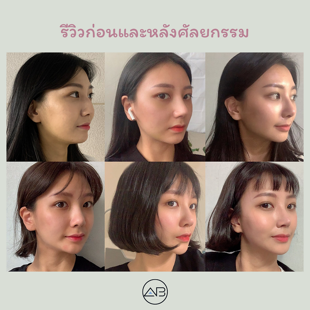 รีวิวศัลยกรรมเหลาจมูกฮัมพ์
