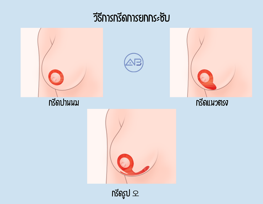 วิธีการศัลยกรรมกรีดหน้าอก