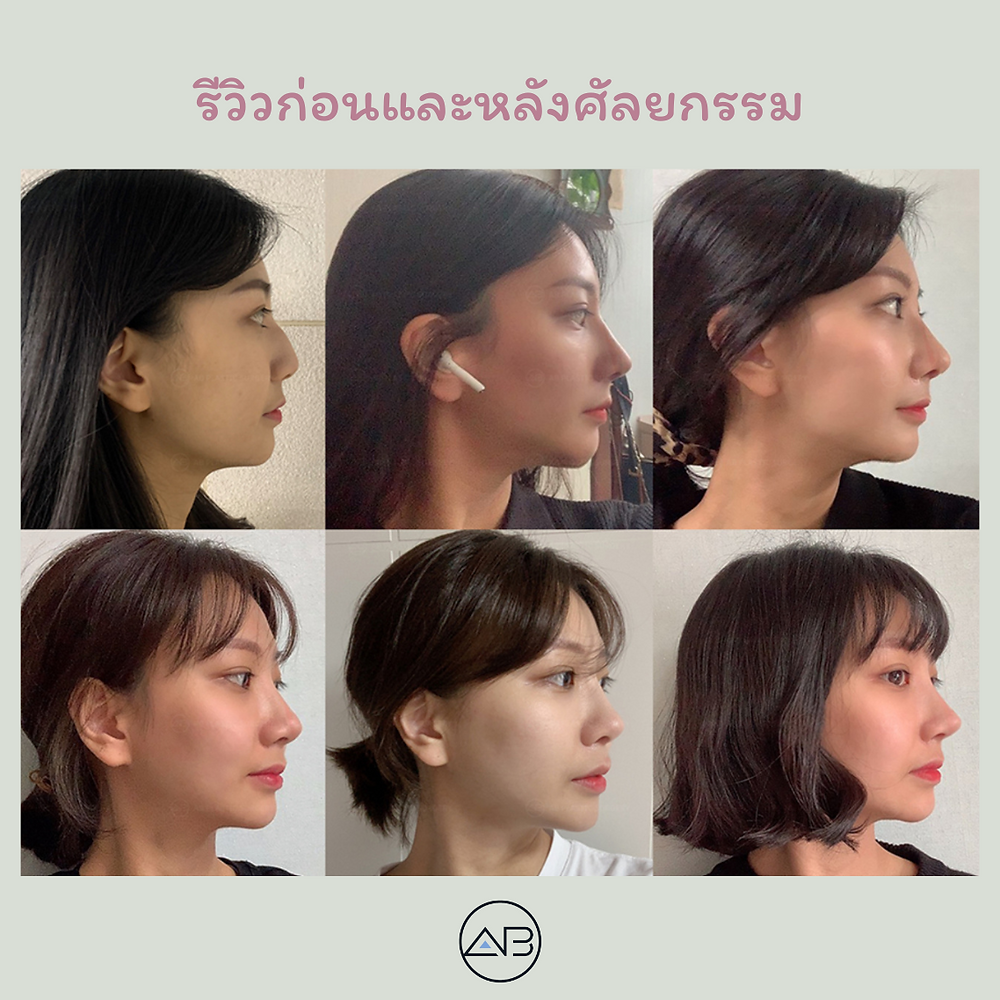 รีวิวศัลยกรรมเหลาจมูกฮัมพ์