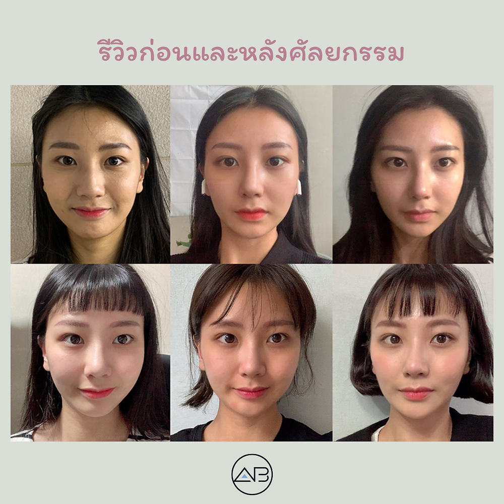 รีวิวศัลยกรรมเหลาจมูกฮัมพ์