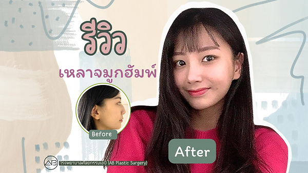 รีวิวศัลยกรรมจมูก เหลาจมูกฮัมพ์ให้เรียวขึ้น จากโรงพยาบาลเอบี (AB Plastic Surgery)