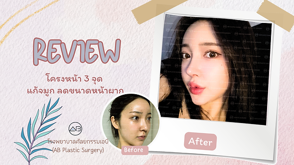 รีวิวศัลยกรรมโครงหน้า แก้จมูก และลดหน้าผาก จากโรงพยาบาลเอบี (AB Plastic Surgery)