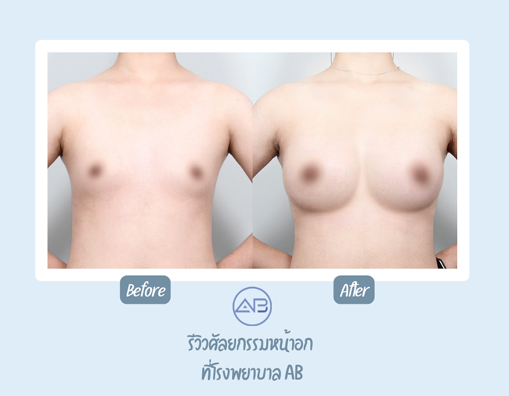 รีวิวศัลยกรรมหน้าอกที่โรงพยาบาลเอบี