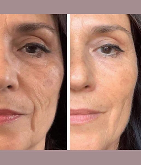 ultraformer-dra-renata-martins-estetica-belo-horizonte