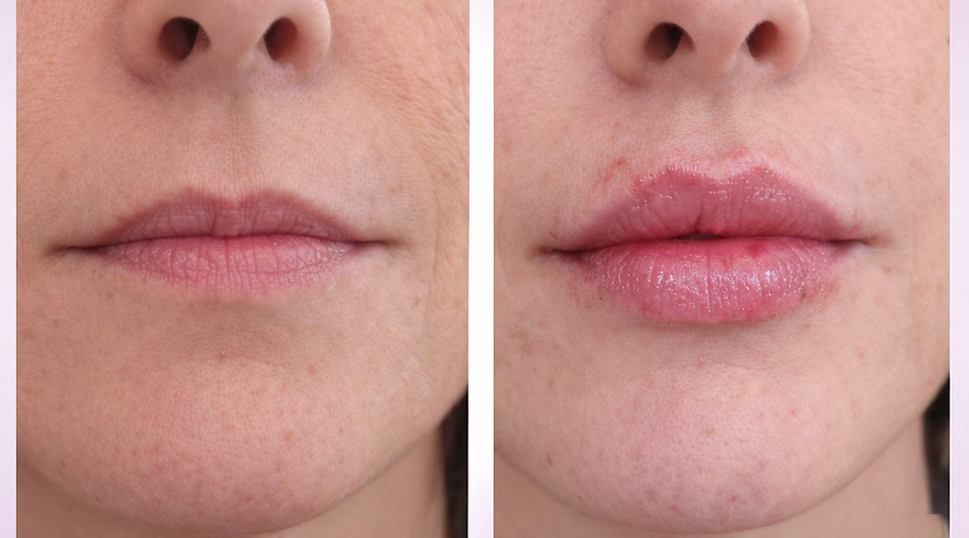 preenchimento-labial-barreiro-bh-90
