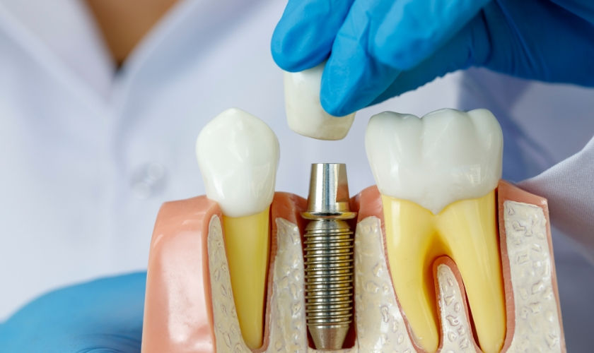 Factors Influencing the Lifespan of Dental Implants