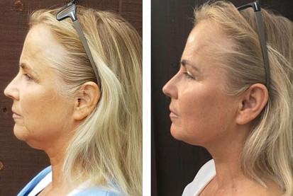 Face yoga before and after results showing natural facelift transformation