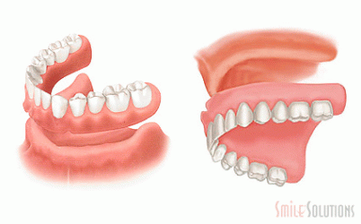 full_denture_402x250.gif