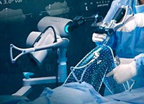 Dr. Yadwinder Singh performing robotic-assisted knee replacement surgery using advanced Velys technology, displaying digital metrics on-screen to ensure precise alignment and measurements, showcasing the integration of modern robotics in joint replacement procedures."