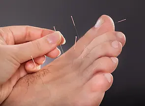 acupuncture on man's foot