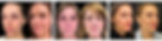 Before and Afters of Gaunt/Hollowing Aging Type Avatars