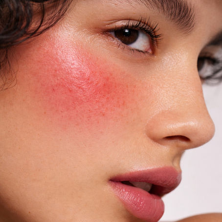Rosacea: Why Your Skin Isn’t Improving (And What to Do Instead)