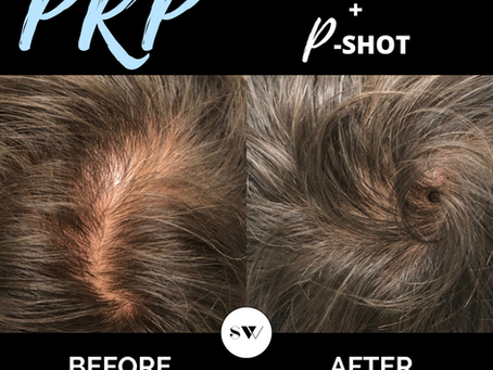 Dealing With Erectile Dysfunction and Hair Loss After 40