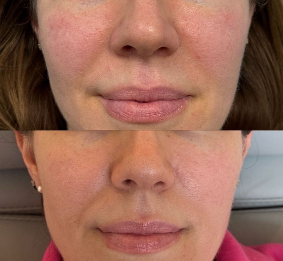 Micro Tox For Facial Redness