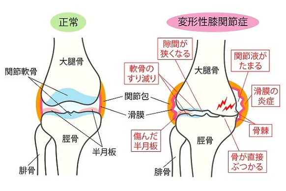 変形性膝関節症のイラスト