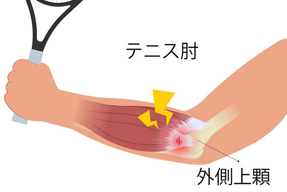 テニス肘さん専用です。 テニス肘（上腕骨外側上顆炎） | あさひ鍼灸整骨院【大船駅3分】保険