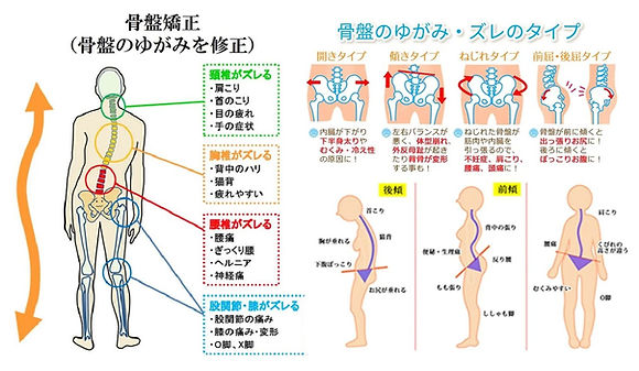 骨盤の歪みやズレを修正