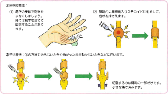 ばね指の治療方法