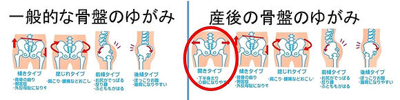 一般的な骨盤の歪みと産後の骨盤の歪み.