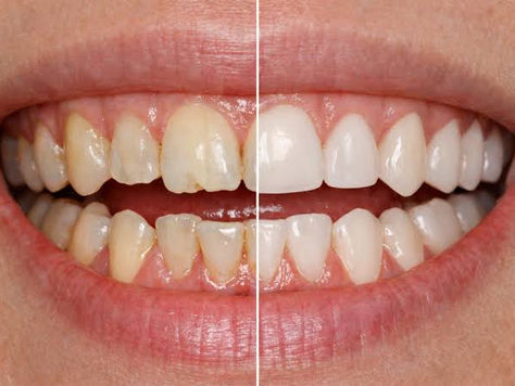 5 Best Veneers Clinics in Melbourne (2026 Guide)