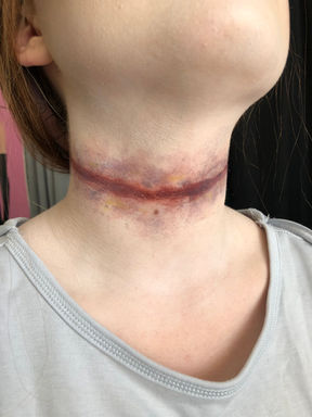 Witch in the Woods: Allie/ghost, close up of final neck makeup, defined line bruise on neck surrounded in more stippled bruises. 