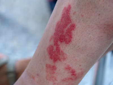 Vasculitis: una enfermedad poco común, pero mortal