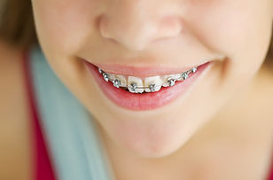 Silver braces